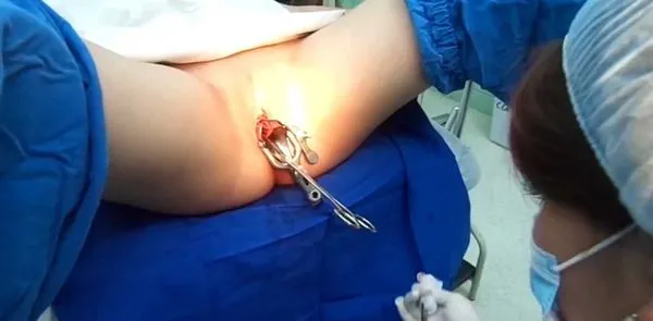 猎奇 人流 操作规范流程 慎点 ！不喜欢这口的一定不要点开！！！